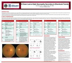 A Closer Look at Optic Neuropathy Secondary to Ethambutol Toxicity